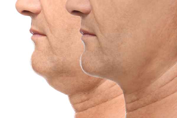 HIFU - Breakthrough in Anti - ageing 2 hifu results Isle of Isla