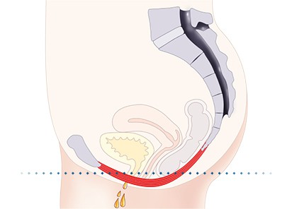 Pelvic-Floor Muscle Repair 5 Pelvic floor muscles Isle of Isla