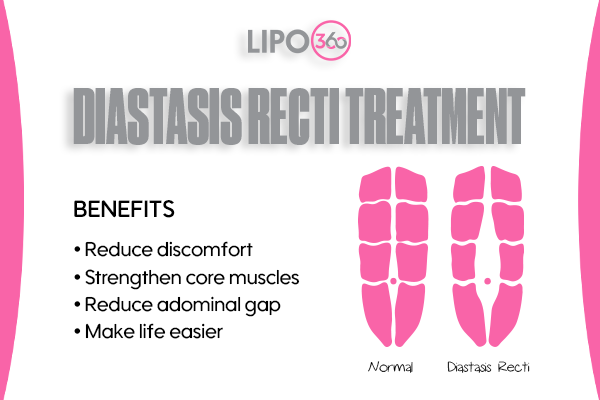 Revolutionising Muscle Repair: The Power of LIPO360 Body Sculpt Post-Injury 5 diastasis recti treatment Isle of Isla