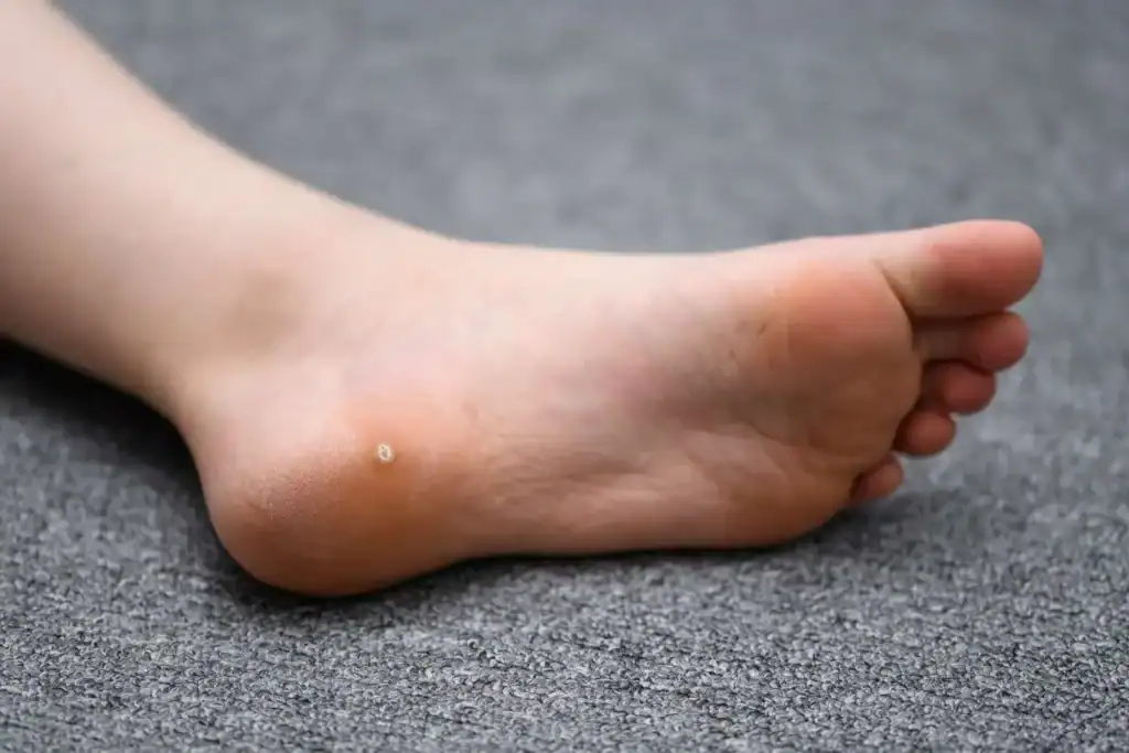 Cryotherapy For Warts And Also Verrucas 2 Image of verruca on the bottom of the foot that able to be treated with Cryotherapy Isle of Isla