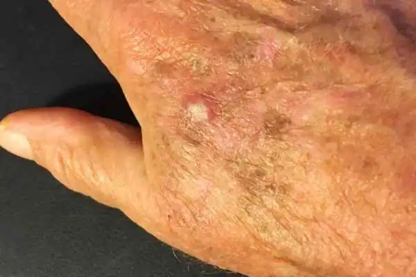 Cryopen For Actinic Keratoses 1 Image of Actinic keratoses Isle of Isla on a person hand