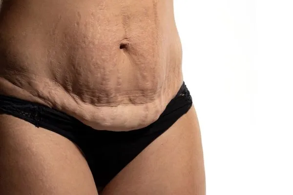 The science behind skin tightening Isle of Isla picture of a woman's sagging skin on the stomach